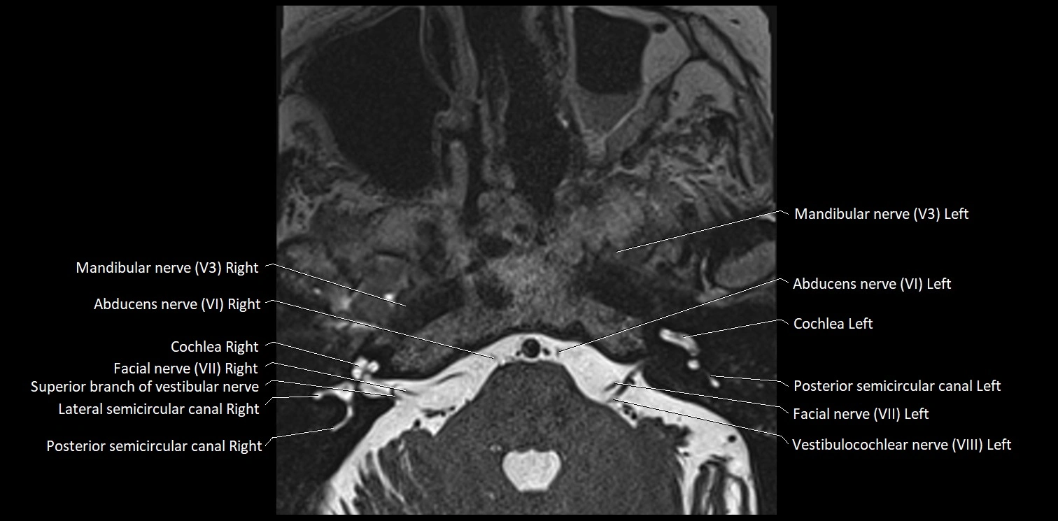 Cranial nerve anatomy axial MRI 3T image 55.webp